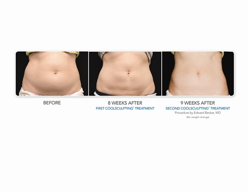 Image related to Coolsculpting Boca Raton Florida